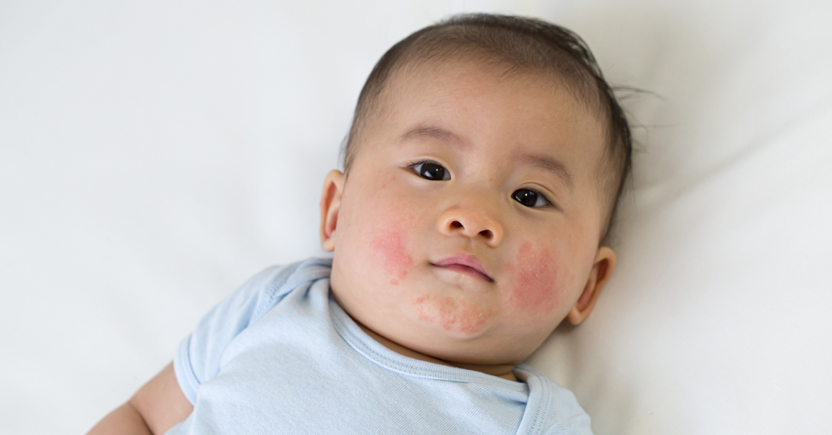 8 Effective Home Remedies for Drool Rash in Babies