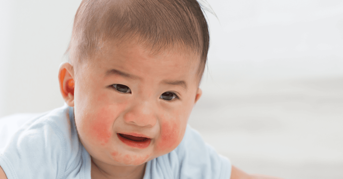 Baby Hives: Common Triggers and Signs It's Serious