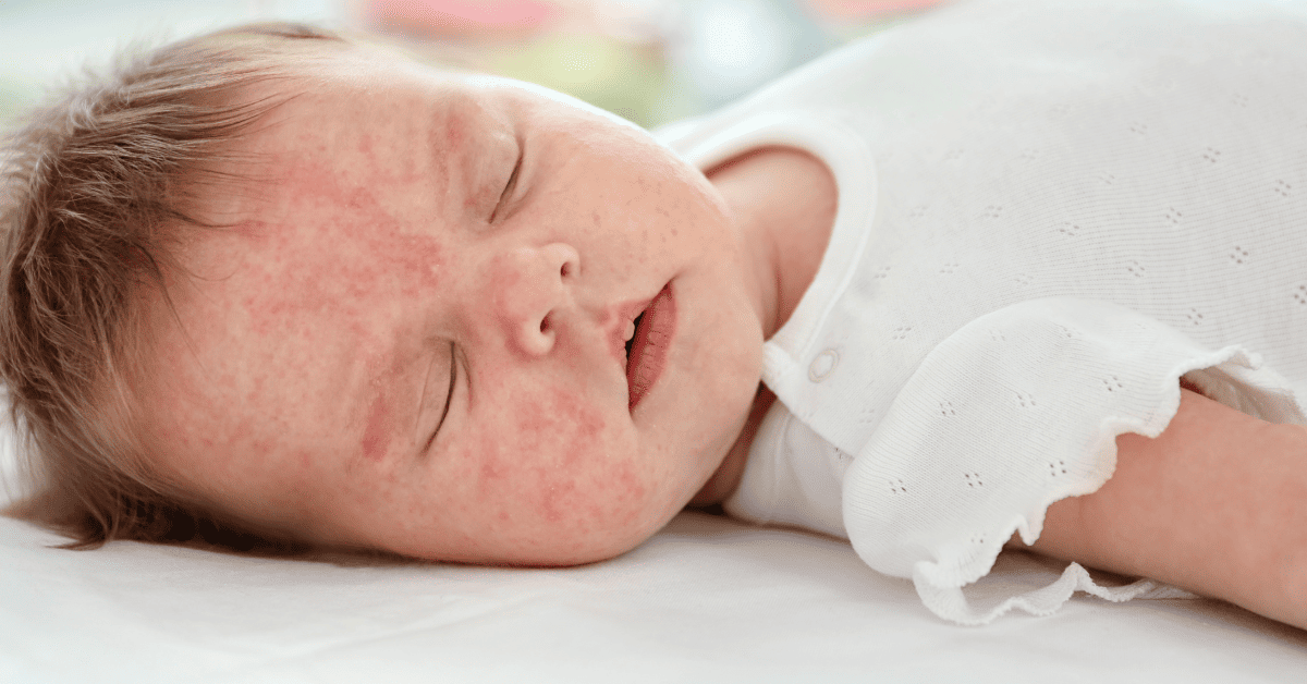 Baby Bed Bug Bites: Symptoms and Solutions for Parents